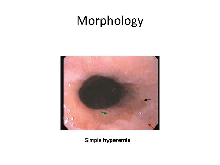 Morphology Simple hyperemia 