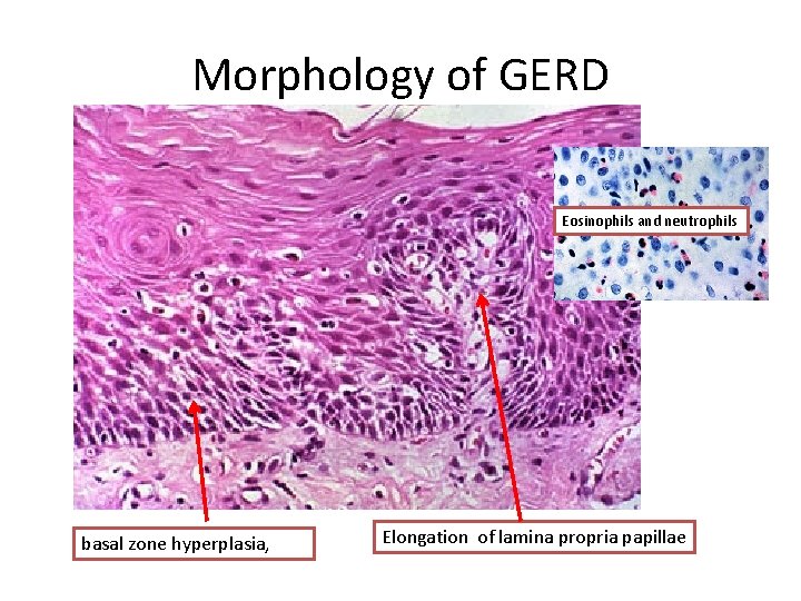 Morphology of GERD Eosinophils and neutrophils basal zone hyperplasia, Elongation of lamina propria papillae