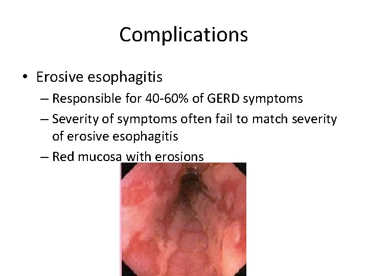 Complications • Erosive esophagitis – Responsible for 40 -60% of GERD symptoms – Severity
