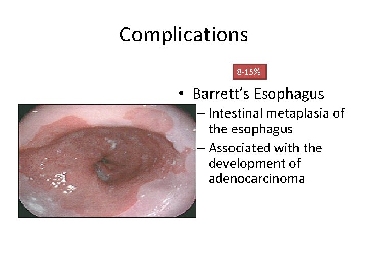 Complications 8 -15% • Barrett’s Esophagus – Intestinal metaplasia of the esophagus – Associated