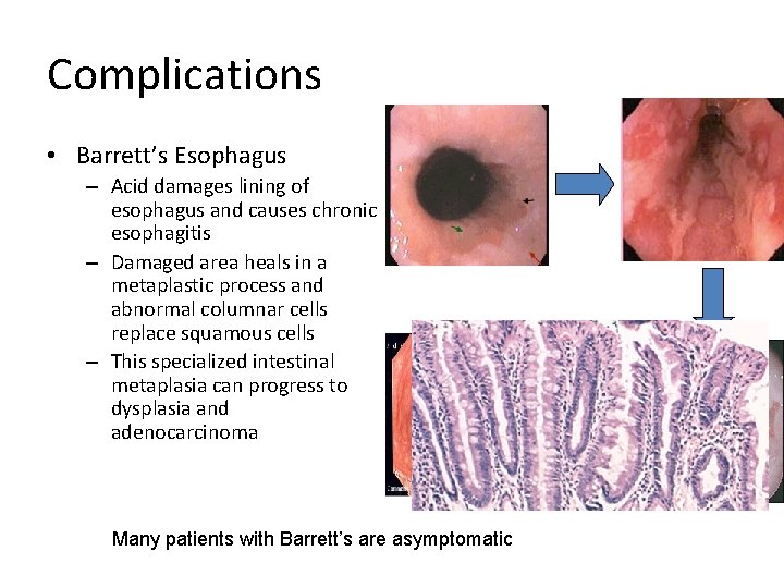 Complications • Barrett’s Esophagus – Acid damages lining of esophagus and causes chronic esophagitis