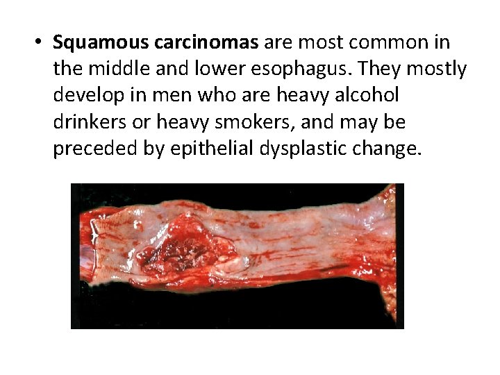  • Squamous carcinomas are most common in the middle and lower esophagus. They