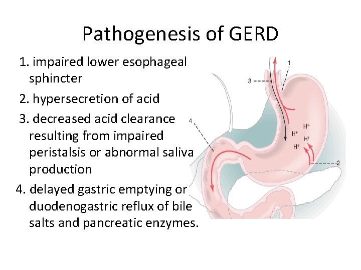 Pathogenesis of GERD 1. impaired lower esophageal sphincter 2. hypersecretion of acid 3. decreased