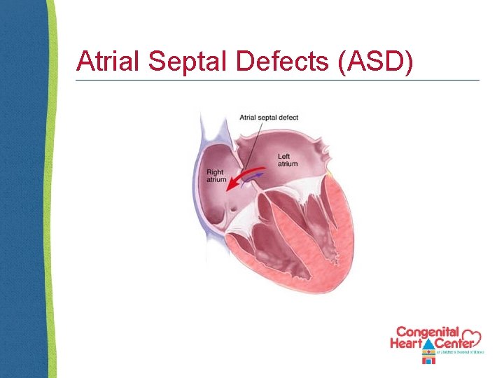 Atrial Septal Defects (ASD) 