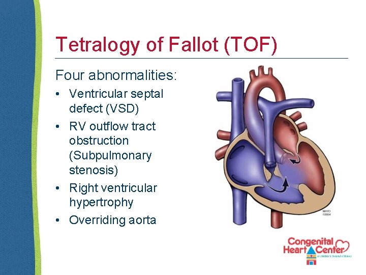 Tetralogy of Fallot (TOF) Four abnormalities: • Ventricular septal defect (VSD) • RV outflow