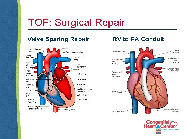 TOF: Surgical Repair Valve Sparing Repair RV to PA Conduit 