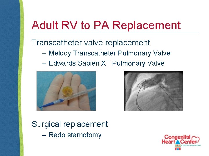 Adult RV to PA Replacement Transcatheter valve replacement – Melody Transcatheter Pulmonary Valve –