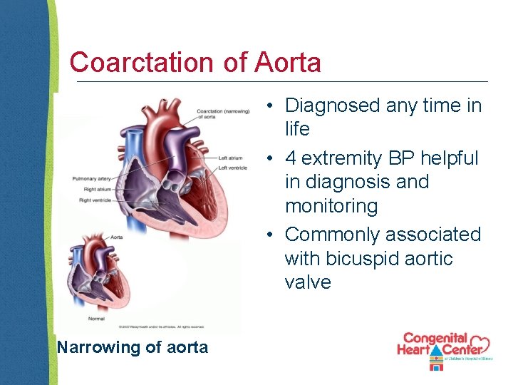 Coarctation of Aorta • Diagnosed any time in life • 4 extremity BP helpful