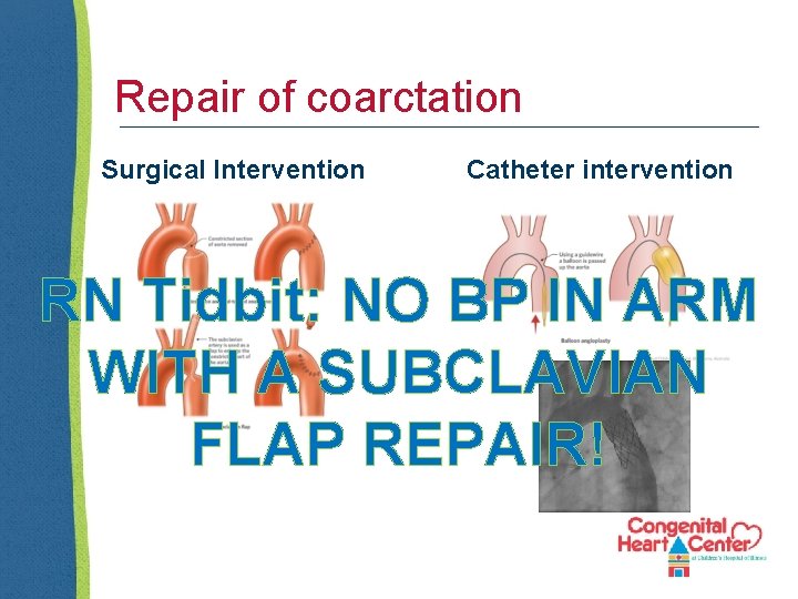 Repair of coarctation Surgical Intervention Catheter intervention RN Tidbit: NO BP IN ARM WITH
