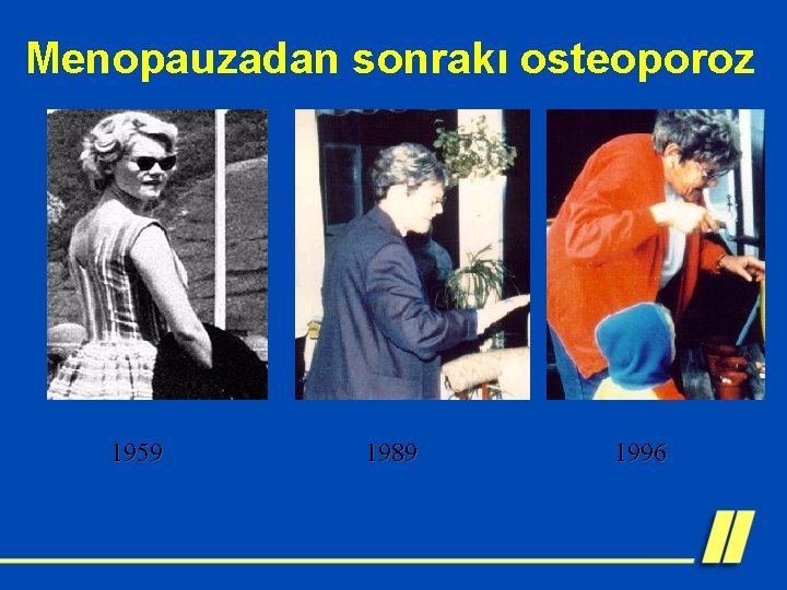 Menopauzadan sonrakı osteoporoz 1959 1989 1996 