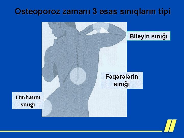 Osteoporoz zamanı 3 əsas sınıqların tipi Biləyin sınığı Fəqərələrin sınığı Ombanın sınığı 