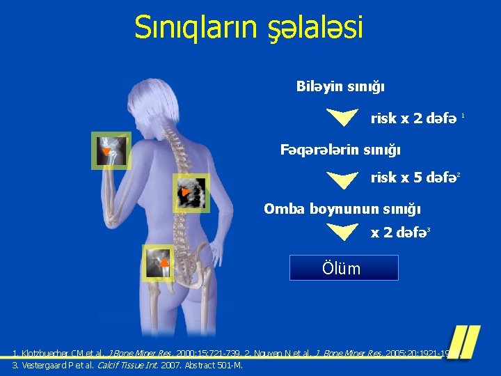 Sınıqların şəlaləsi Biləyin sınığı risk x 2 dəfə 1 Fəqərələrin sınığı risk x 5