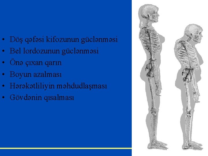  • • • Döş qəfəsi kifozunun güclənməsi Bel lordozunun güclənməsi Önə çıxan qarın