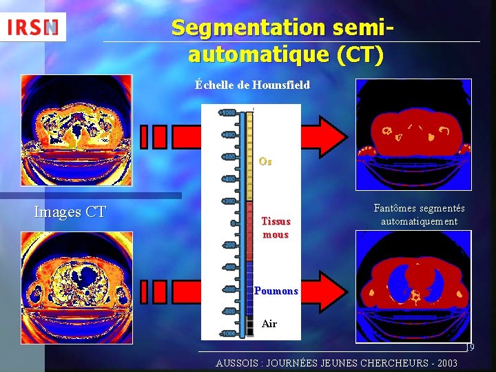 Segmentation semiautomatique (CT) Échelle de Hounsfield Os Images CT Tissus mous Fantômes segmentés automatiquement