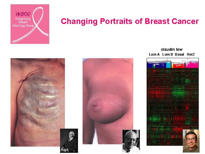 Changing Portraits of Breast Cancer claudin low Lum A Lum B Basal Her 2