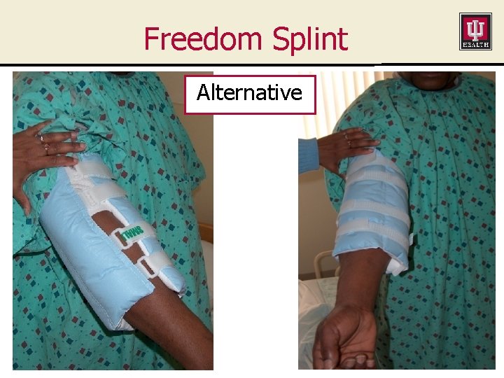 Freedom Splint Alternative 