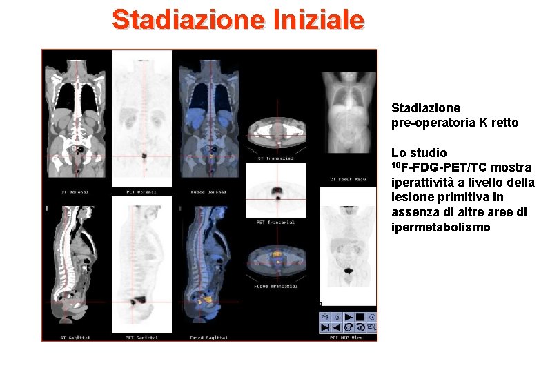 Stadiazione Iniziale Stadiazione pre-operatoria K retto Lo studio 18 F-FDG-PET/TC mostra iperattività a livello