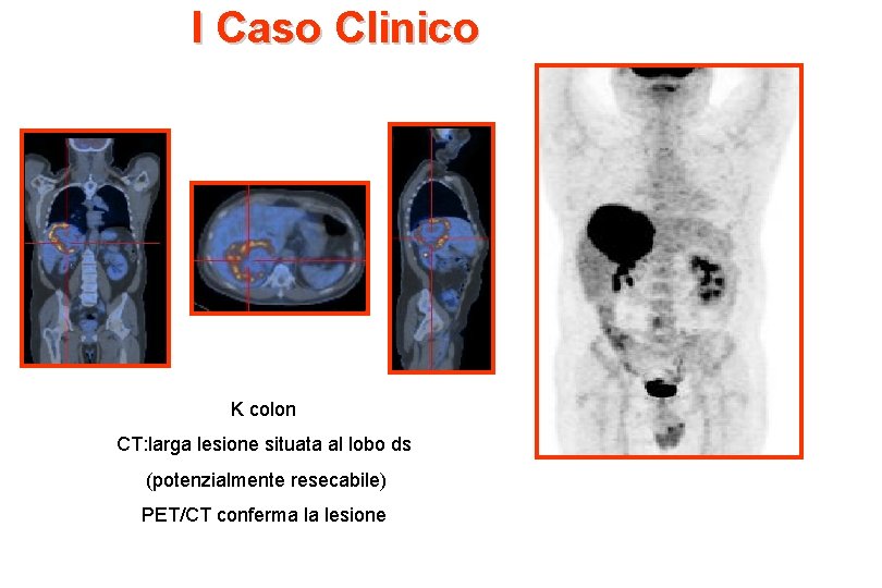 I Caso Clinico K colon CT: larga lesione situata al lobo ds (potenzialmente resecabile)