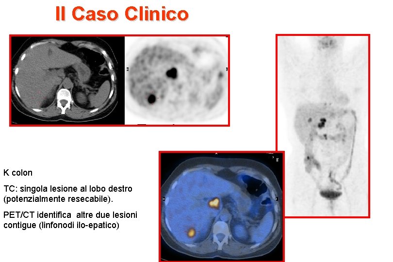 II Caso Clinico K colon TC: singola lesione al lobo destro (potenzialmente resecabile). PET/CT