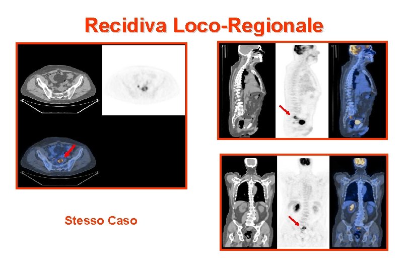 Recidiva Loco-Regionale Stesso Caso 