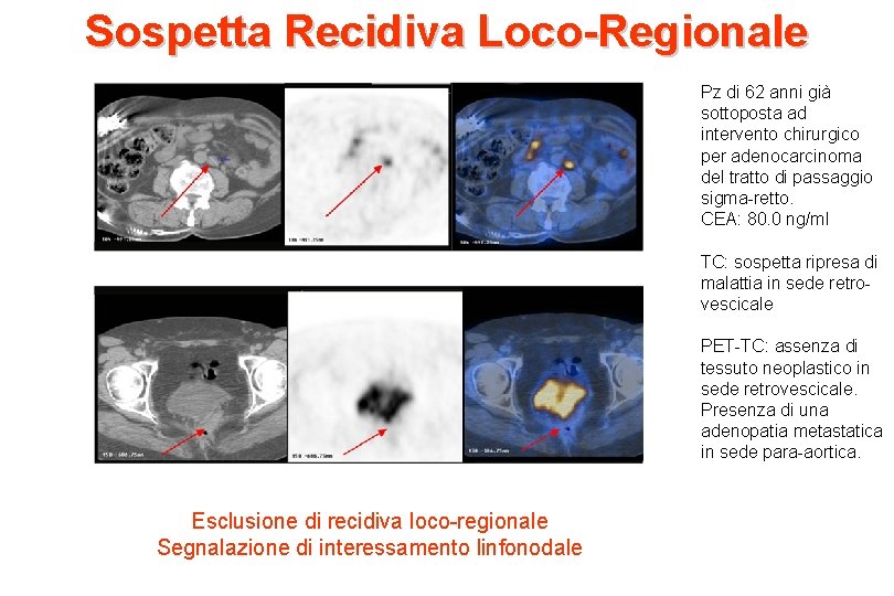 Sospetta Recidiva Loco-Regionale Pz di 62 anni già sottoposta ad intervento chirurgico per adenocarcinoma