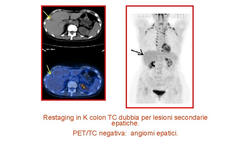 Restaging in K colon TC dubbia per lesioni secondarie epatiche. PET/TC negativa: angiomi epatici.