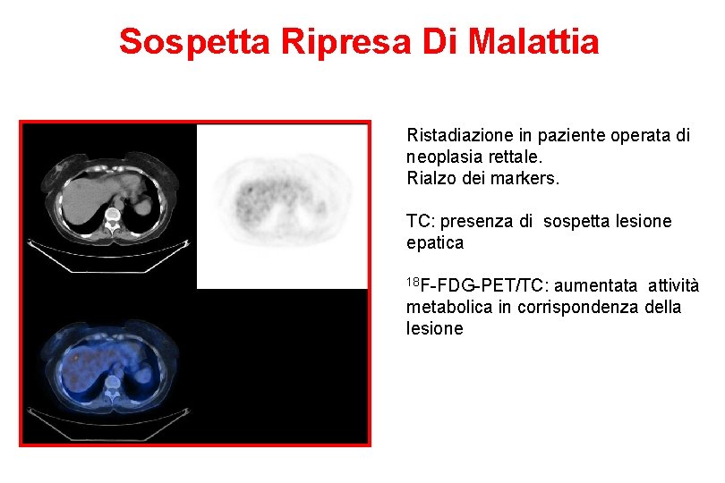 Sospetta Ripresa Di Malattia Ristadiazione in paziente operata di neoplasia rettale. Rialzo dei markers.