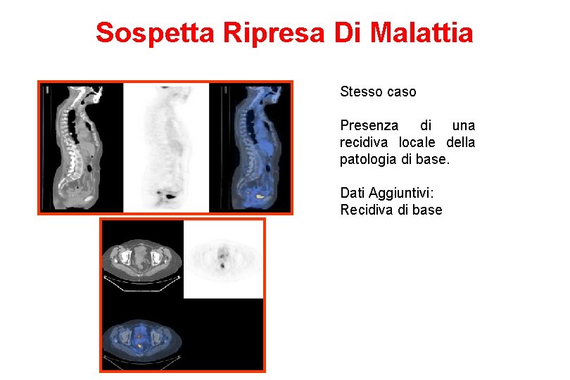 Sospetta Ripresa Di Malattia Stesso caso Presenza di una recidiva locale della patologia di