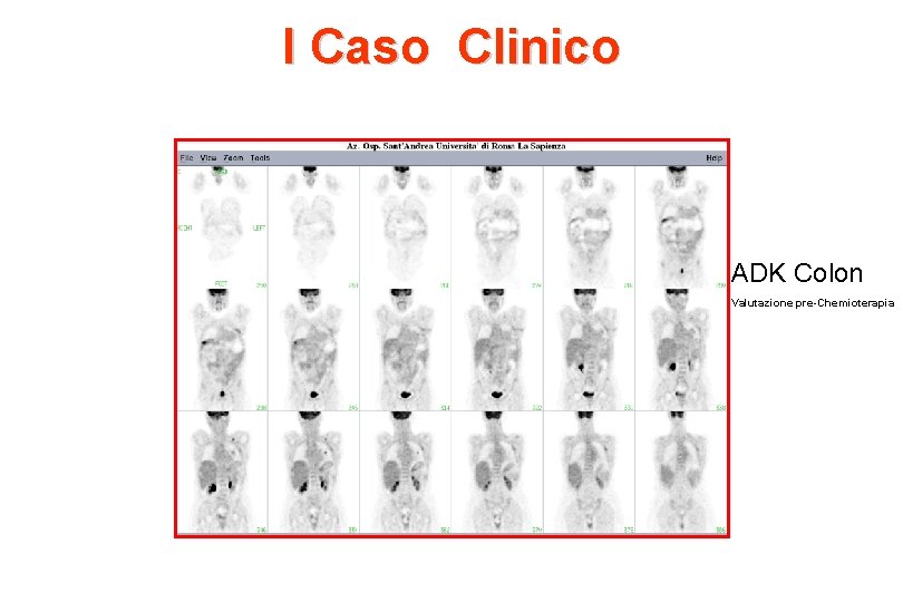 I Caso Clinico ADK Colon Valutazione pre-Chemioterapia 