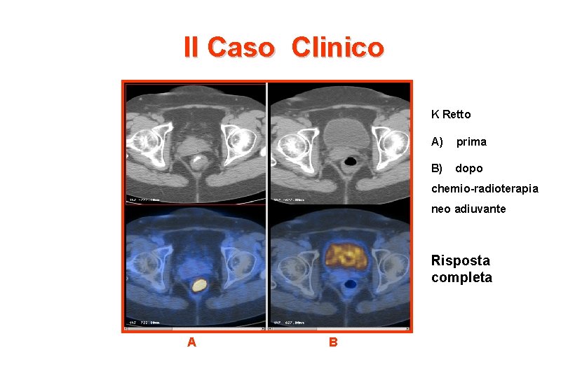 II Caso Clinico K Retto A) prima B) dopo chemio-radioterapia neo adiuvante Risposta completa