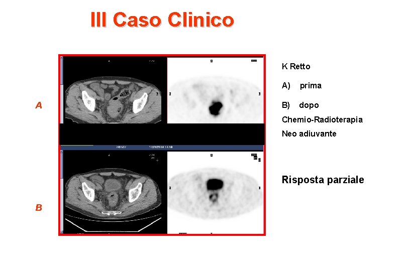 III Caso Clinico K Retto A A) prima B) dopo Chemio-Radioterapia PRE Neo adiuvante