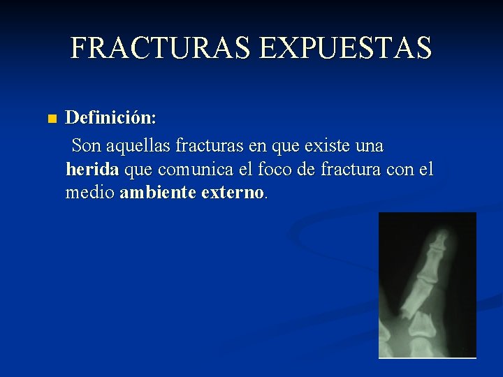 FRACTURAS EXPUESTAS n Definición: Son aquellas fracturas en que existe una herida que comunica