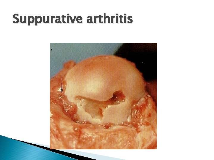Suppurative arthritis 