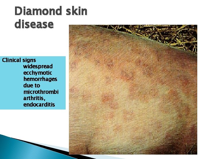 Diamond skin disease Clinical signs widespread ecchymotic hemorrhages due to microthrombi arthritis, endocarditis 