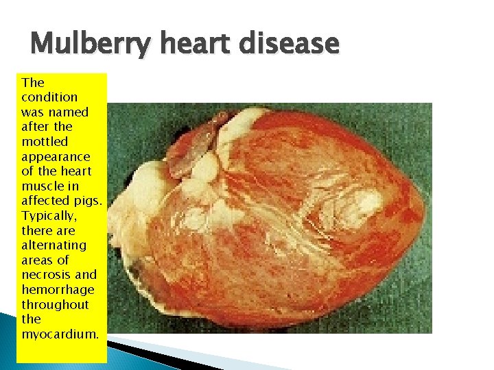 Mulberry heart disease The condition was named after the mottled appearance of the heart