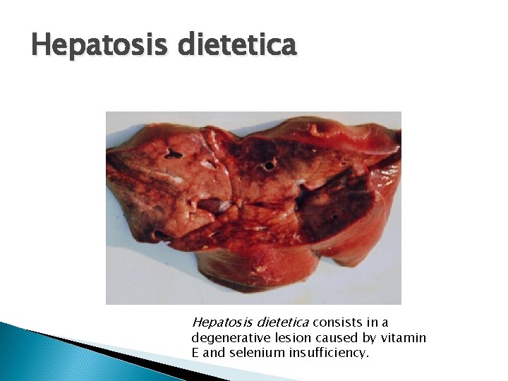 Hepatosis dietetica consists in a degenerative lesion caused by vitamin E and selenium insufficiency.