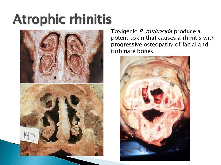 Atrophic rhinitis Toxigenic P. multocida produce a potent toxin that causes a rhinitis with