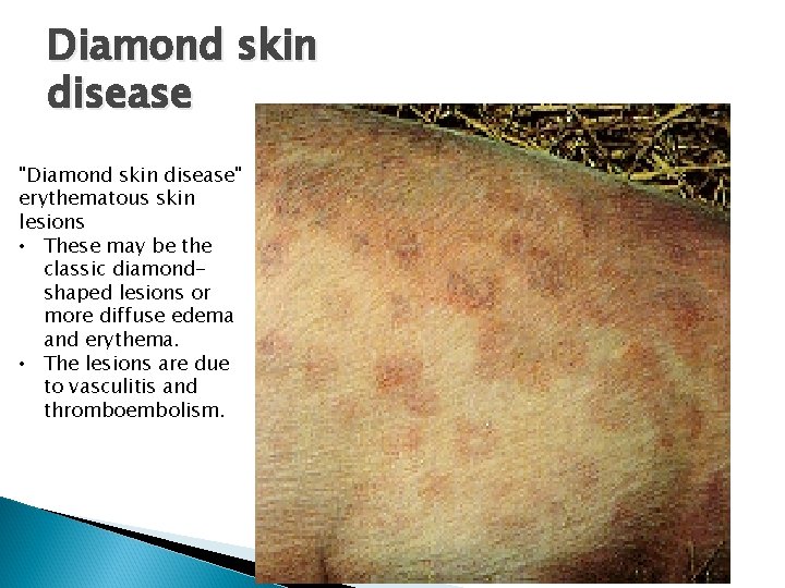 Diamond skin disease "Diamond skin disease" erythematous skin lesions • These may be the