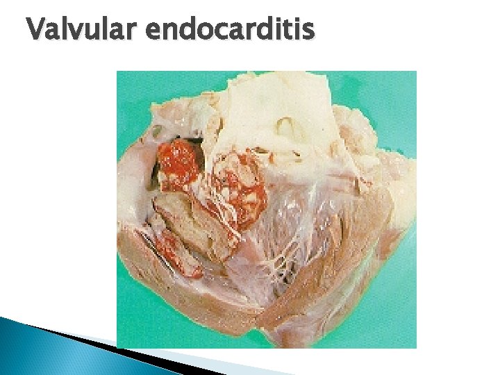 Valvular endocarditis 