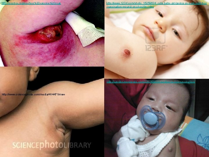 http: //picsbox. biz/key/bcg%20 vaccine%20 scar http: //www. 123 rf. com/photo_15259634_cute-baby-girl-laying-on-back-with-bcg -vaccination-wound-on-shoulder. html http: //cayden.