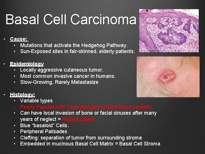 Basal Cell Carcinoma • Cause: • Mutations that activate the Hedgehog Pathway. • Sun-Exposed