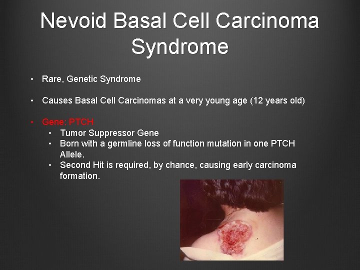 Nevoid Basal Cell Carcinoma Syndrome • Rare, Genetic Syndrome • Causes Basal Cell Carcinomas