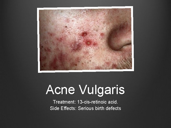 Acne Vulgaris Treatment: 13 -cis-retinoic acid. Side Effects: Serious birth defects 