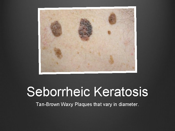 Seborrheic Keratosis Tan-Brown Waxy Plaques that vary in diameter. 