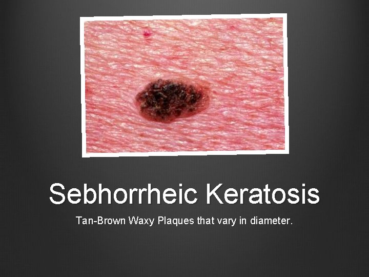 Sebhorrheic Keratosis Tan-Brown Waxy Plaques that vary in diameter. 