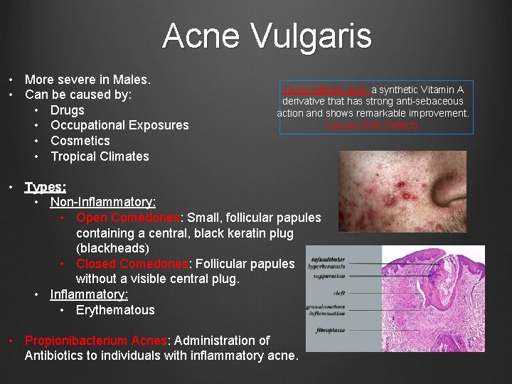Acne Vulgaris • More severe in Males. • Can be caused by: • Drugs