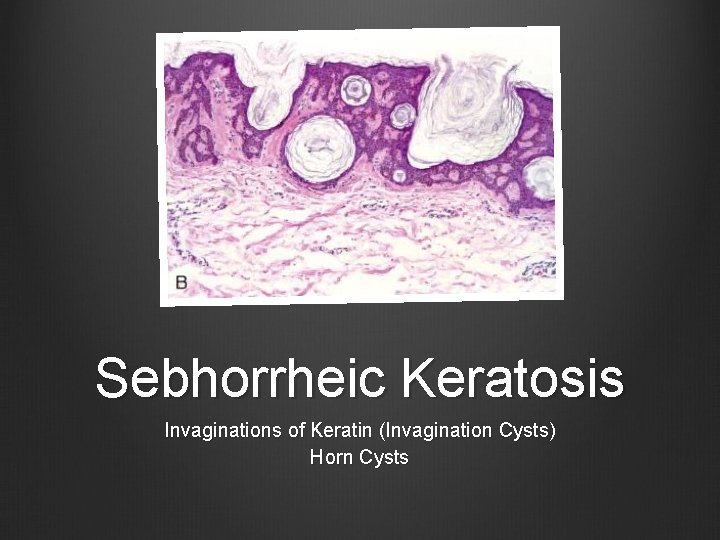 Sebhorrheic Keratosis Invaginations of Keratin (Invagination Cysts) Horn Cysts 
