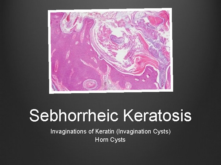 Sebhorrheic Keratosis Invaginations of Keratin (Invagination Cysts) Horn Cysts 