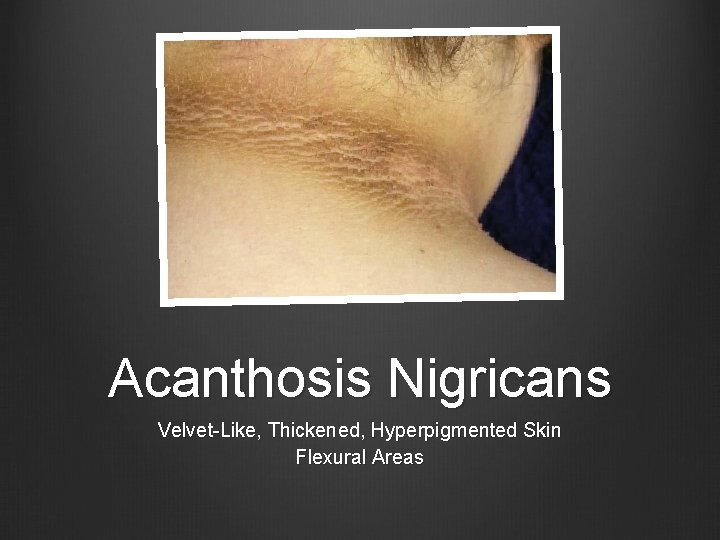 Acanthosis Nigricans Velvet-Like, Thickened, Hyperpigmented Skin Flexural Areas 