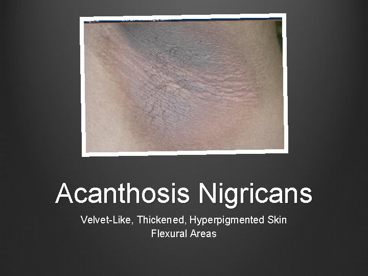Acanthosis Nigricans Velvet-Like, Thickened, Hyperpigmented Skin Flexural Areas 